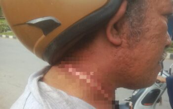 Diduga Terlilit Kabel Internet Menjuntai, Warga Kendari Alami Luka di Leher